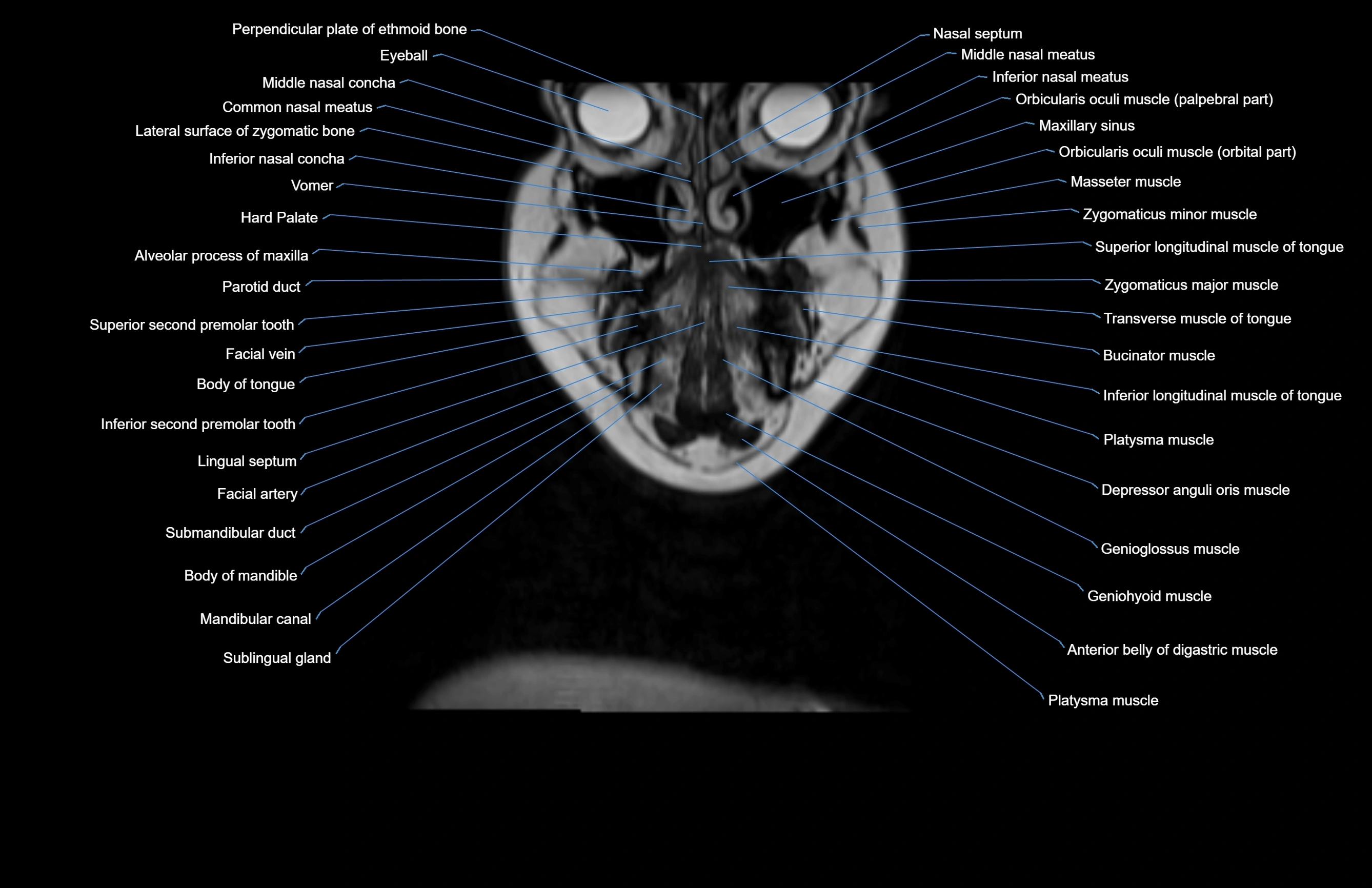 Neck coronal cross sectional MRI anatomy 3T MRI  image-img-00001-00064.webp